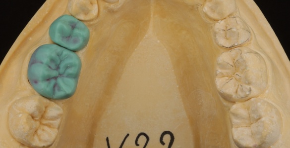 Dent 4.jpg
